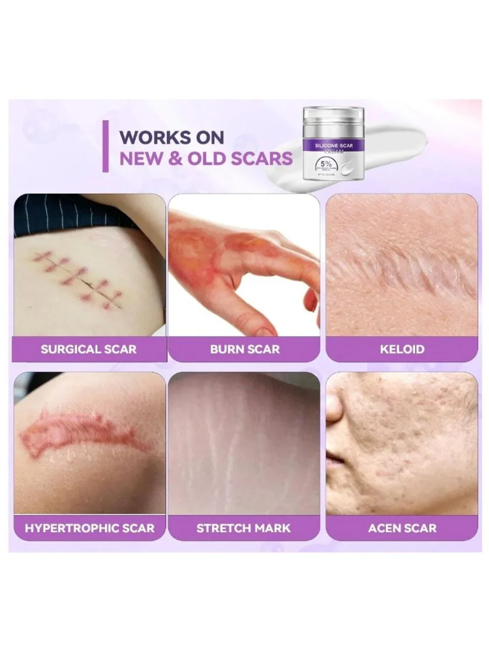 Silicone Scar Cream Removal Surgical Stretch Marks C-Section Keloid Injury Acne